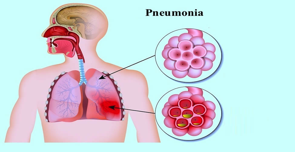 Pneumonia