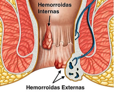 Hemorroida