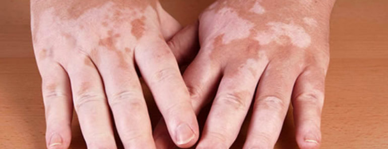 Vitiligo-Mancha-na-Pele