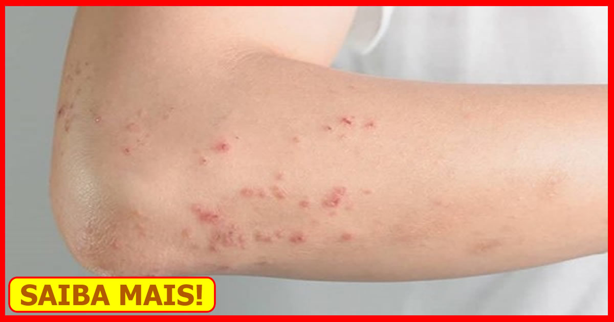 Dermatite O Que Causas Sintomas E Tratamento