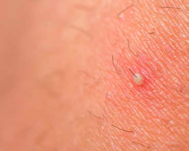 Foliculite um tipo de infecção da pele